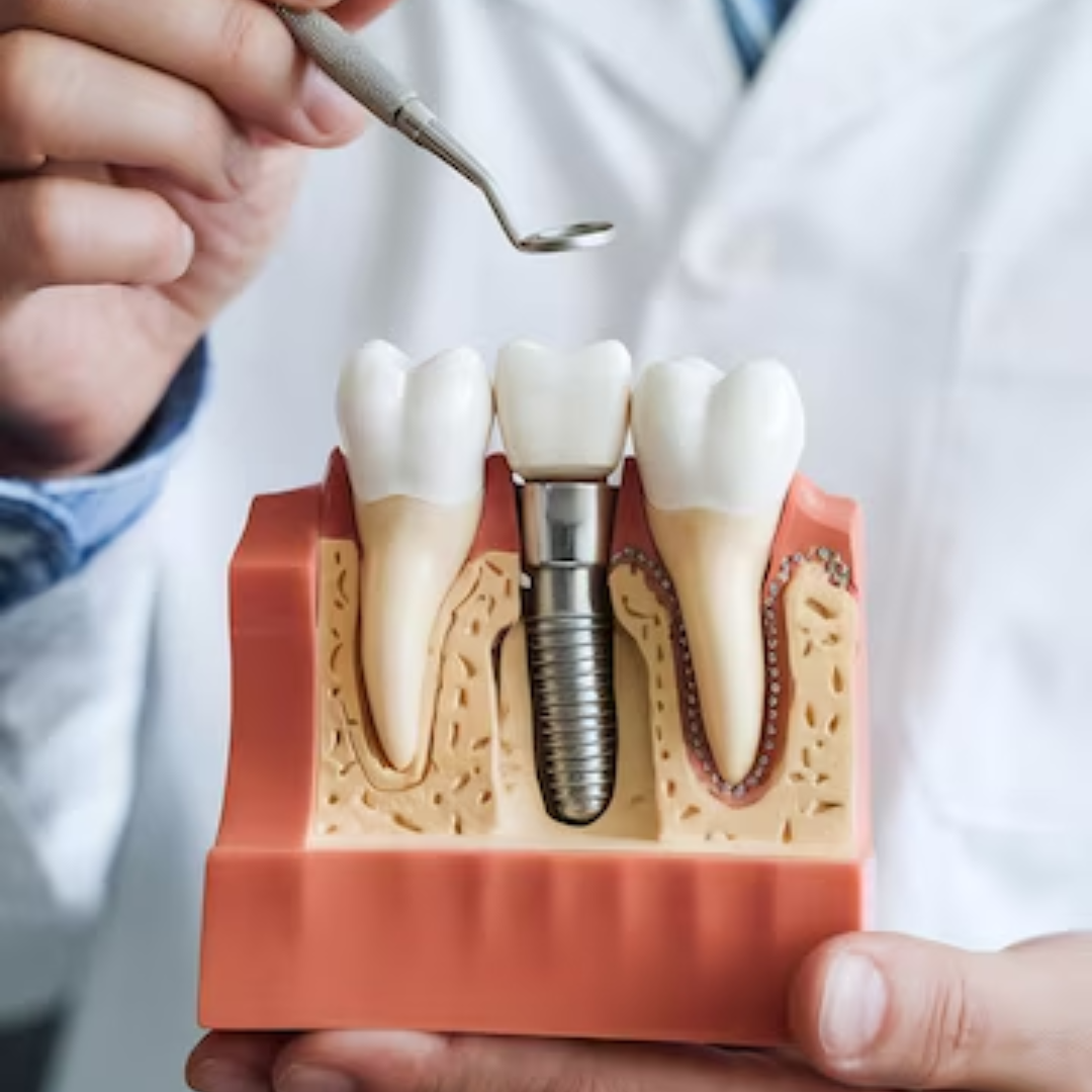 Implantodontia: Recupere Seu Sorriso com Implantes Dentários